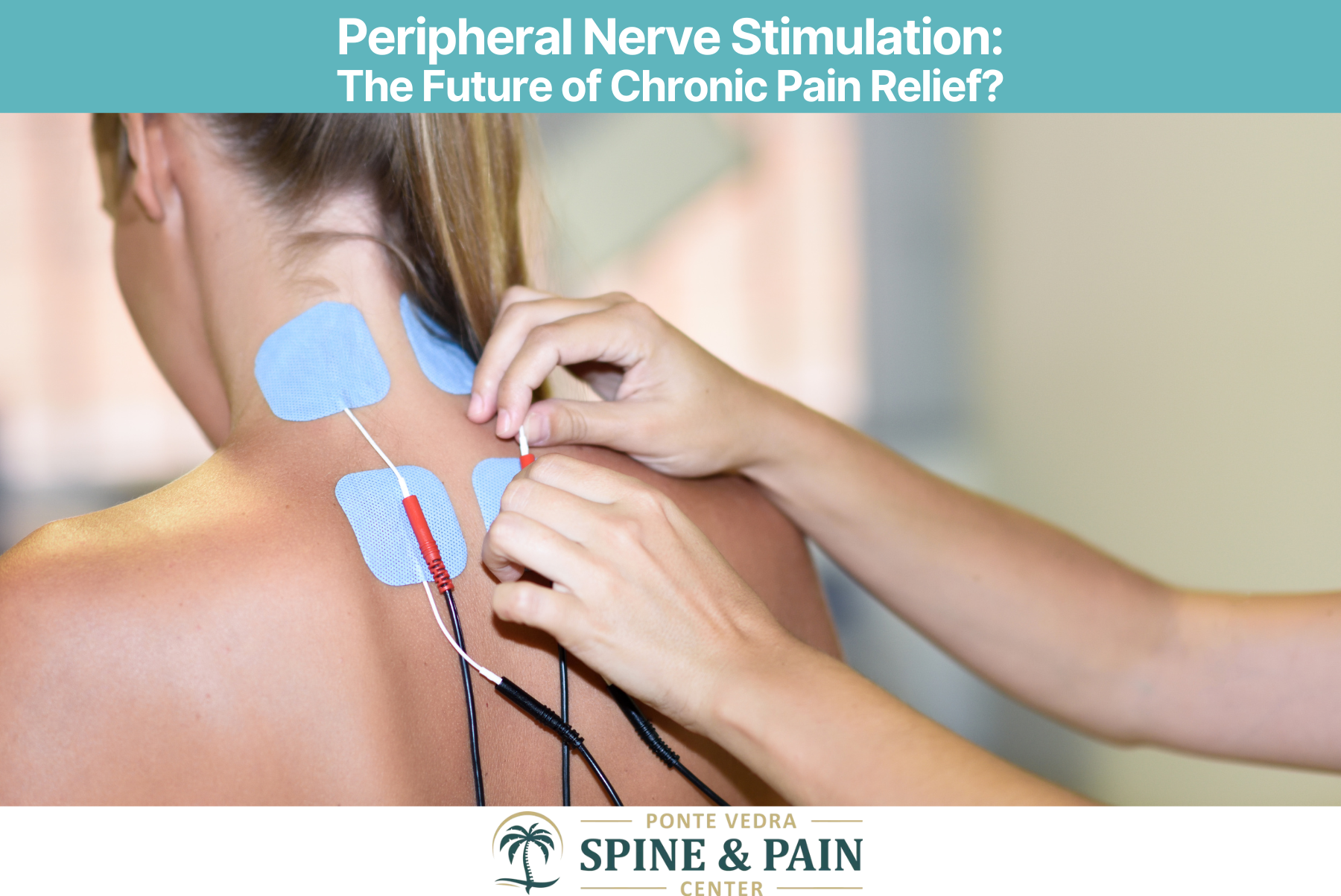 Peripheral Nerve Stimulation The Future of Chronic Pain Relief